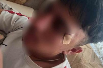 Öğretmenin kafa attığı çocuğun burnu kırıldı