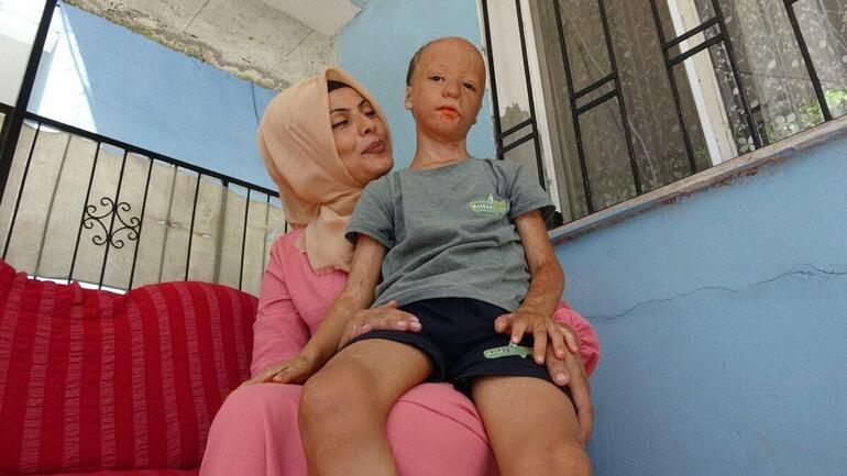 Yangında yaralanan 9 yaşındaki Halil, 3'üncü kez doku nakli için bekliyor