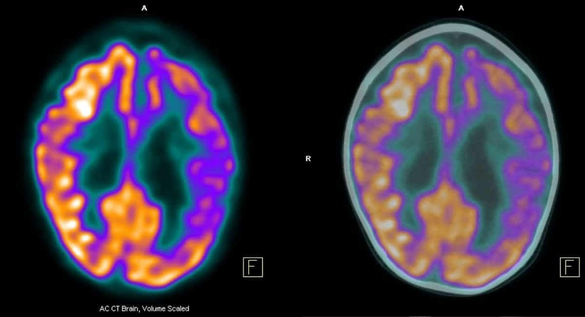 Bilim insanları açıkladı: Alzheimer hastalığı yapay zeka ile tarihe karışabilir!