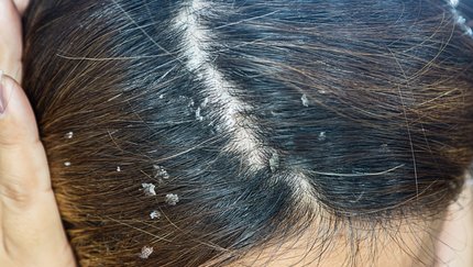 Saç egzaması nedir, neden olur? Saç egzaması tedavisi nedir? Saç egzaması nasıl geçer, kesin çözüm nedir? Saç egzaması için losyon var mı, bulaşıcı mı