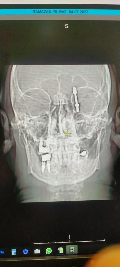 Diş implantı, çene kemiği ile 'orbita tabanı'nı delip, beyin omurilik sıvısına girdi