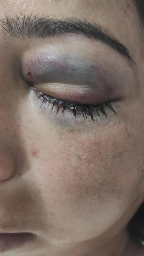 Eşinden şiddet gördüğü için evi terk eden kadını, erkek kardeşi de sopayla dövdü