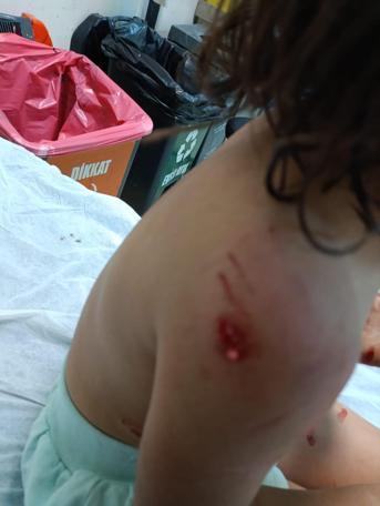 Şanlıurfa'da köpeklerin saldırdığı 4 yaşındaki Eylül, yaralandı